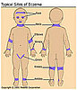 Treatment of Baby Eczema