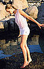 New Varicose Veins Treatment Approved by FDA