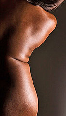 Stretch Mark Advice Stretch Mark Advice