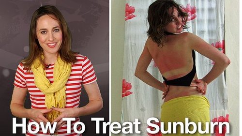 How to Treat Sunburn: Remedies and Tips on Treating Sunburn