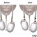 Vasectomy