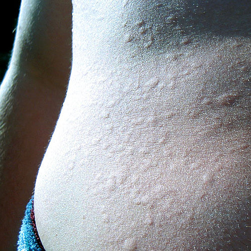Swimming Gives You a Bad Case of Hives Swimming Gives You a Bad Case of Hives