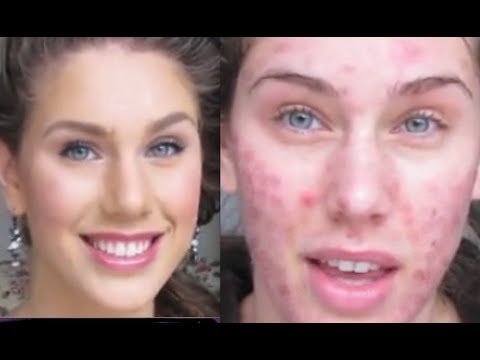 Makeup Tips For Acne Sufferers