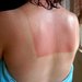 Sunburns
