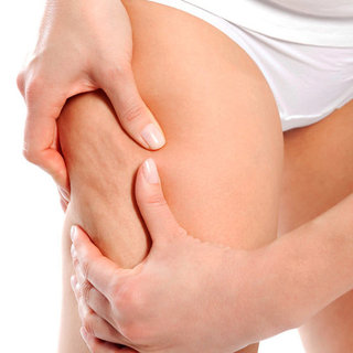 What Cellulite Treatments Work