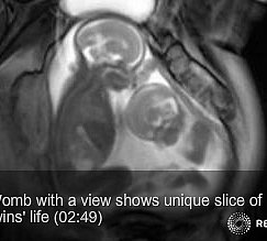 Twins Fighting in Womb, Captured on Video!