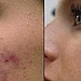 Acne Removal Facial 
