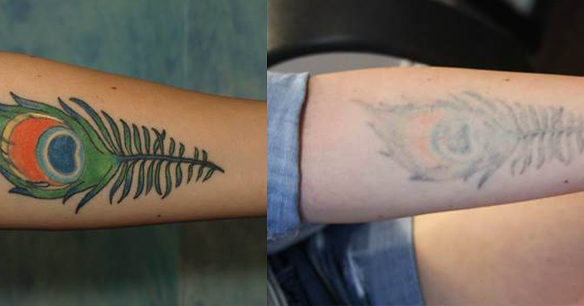 How to Get Rid of a Tattoo POPSUGAR Beauty
