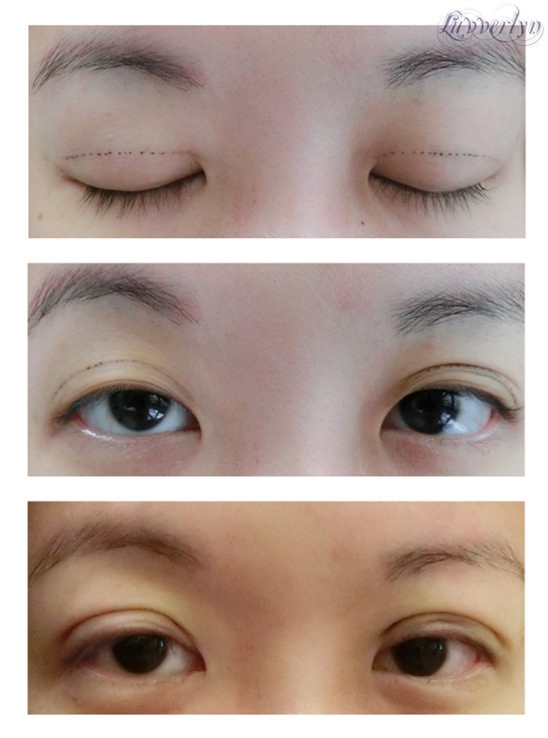 tapered double eyelid