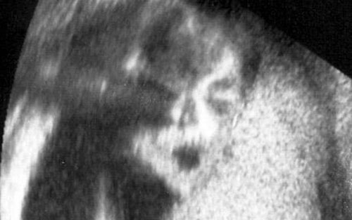 Man in the Mirror or Plain Old Ultrasound?