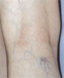 TEENAGER WITH SPIDER VEINS