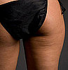 Do You Have Cellulite?