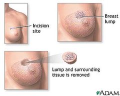 Lumpectomy Procedure 