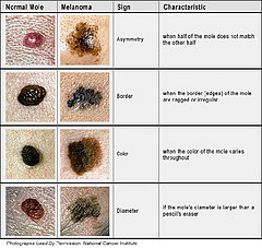 4 Warning Signs of Skin Cancer