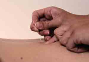 Got Cramps? Try Acupuncture