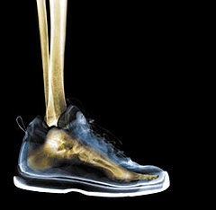 A Pain in Heel: Plantar Fasciitis A Pain in Heel: Plantar Fasciitis