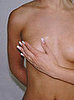 Mastitis