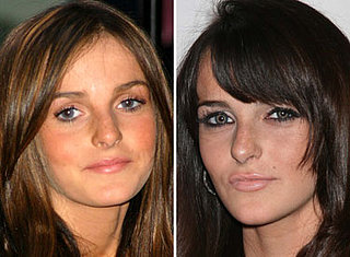 Ali Lohan Gets Lip Injections