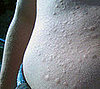 Swimmer's Issue: Allergy to Cold Water?