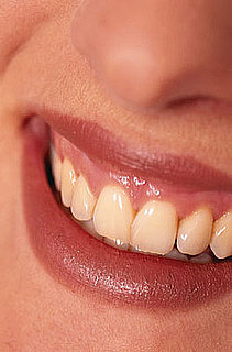 Professional Teeth Whitening: What You Should Know
