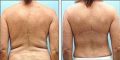 Would You Consider Back Fat Surgery?