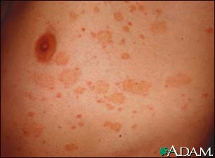 Common Skin Problem: Pityriasis Rosea