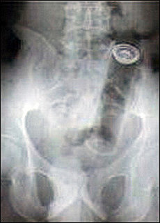 Guess What X-Rays Reveal Is Stuck in This Woman's Bum?