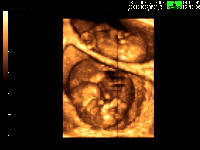 9-Year-Old Girl Had Twin in Stomach