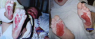 Who Is Responsible for 2nd Degree Burns on Kids' Feet?  