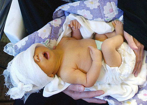 What Do You Know About Newborn Jaundice?