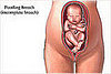 Breech Babies