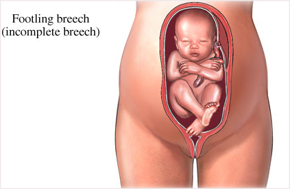Breech Babies