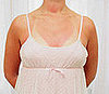 Pregnant Sunburn