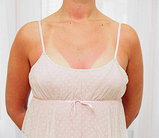 Pregnant Sunburn