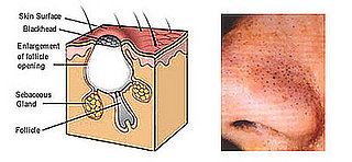 Definition: Blackheads