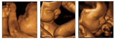 Would You Pay Out of Pocket for a 4D Ultrasound?