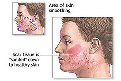 Dermabrasion Dermabrasion