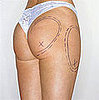 Vanity Poll: Would You Try SmartLipo?