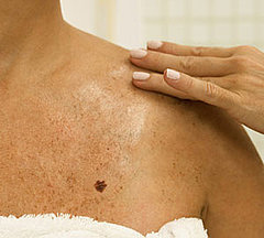 How to Tell If a Mole Is Cancerous