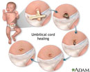 Caring for Umbilical Cord