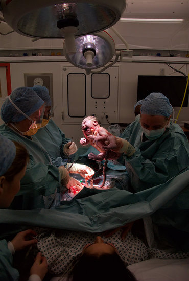 Cesarean Section Cesarean Section