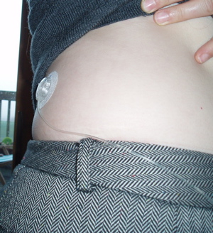 Diabetic Woman Explains the Pros and Cons of Switching to an Insulin Pump