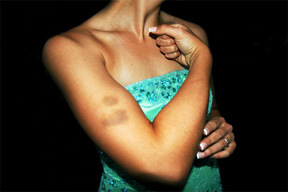 Why Do I Bruise So Easily?