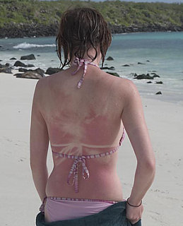 Sunburn For A Sun Tan?