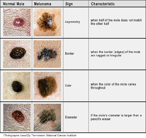 4 Warning Signs of Skin Cancer