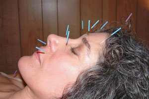Acupuncture Face Lift