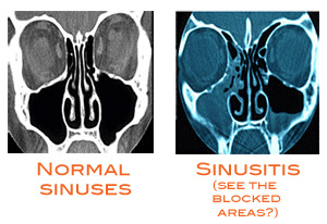 Allergies and Chronic Sinusitis