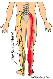 What's the Deal With:  Sciatica