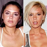 Celebrity Plastic Surgery
