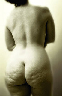Cellulite